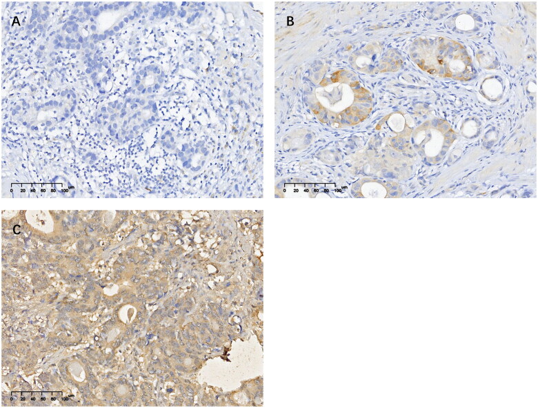 The expression and prognostic predictive value of PD-L2 in patients undergoing radical gastric cancer surgery.