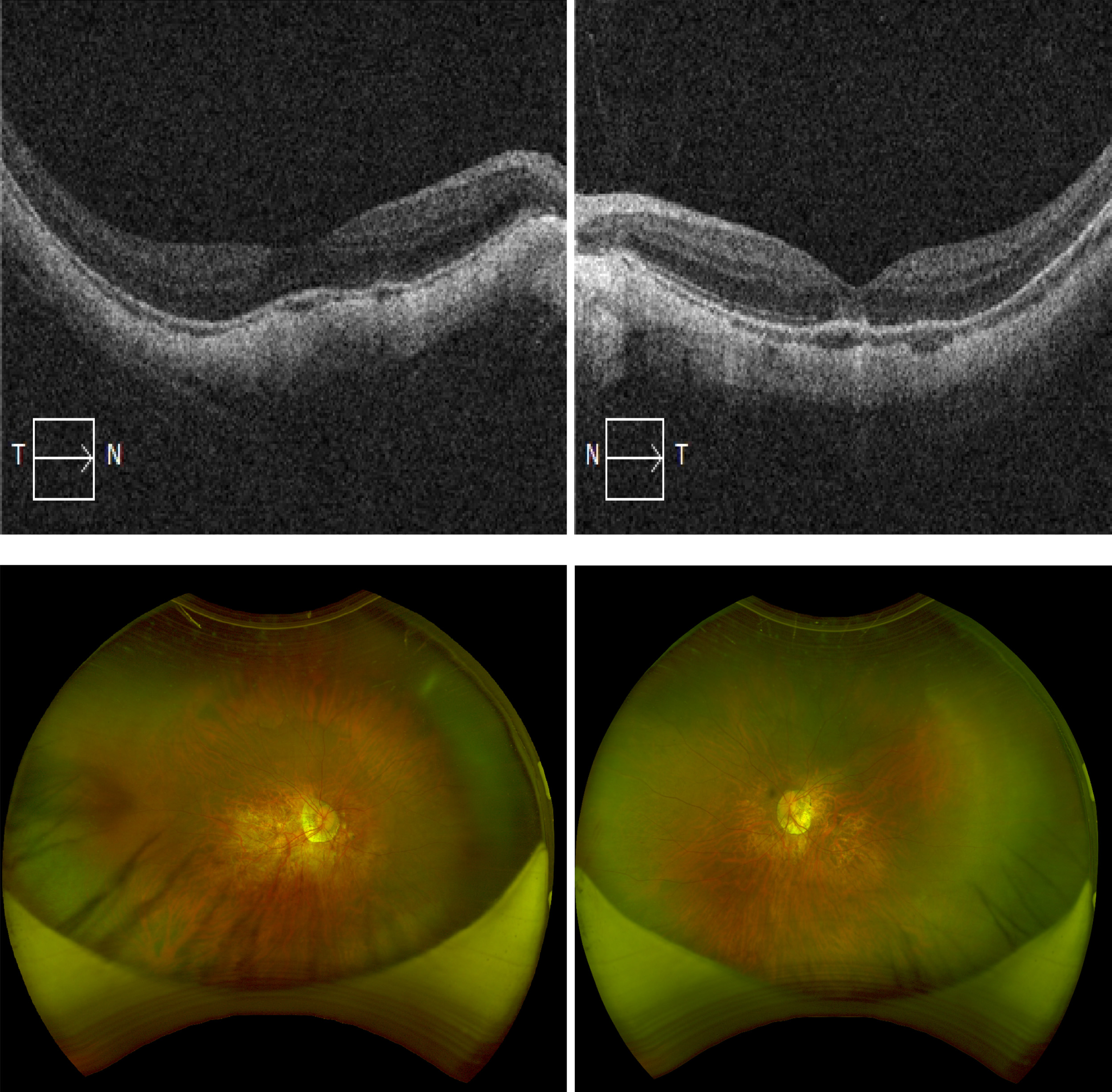 Five years comparation of efficacy and safety after ICL-V4c implantation for high and super high myopia correction.