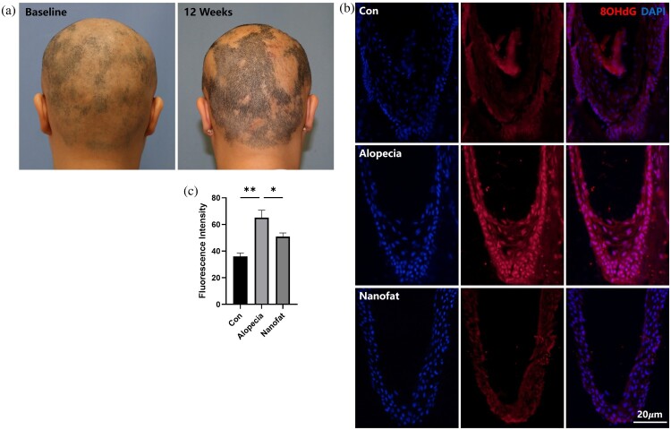 Oxidative stress activates the transplanted adipose-derived stem cells to exert antioxidant effects in alopecia treatment.