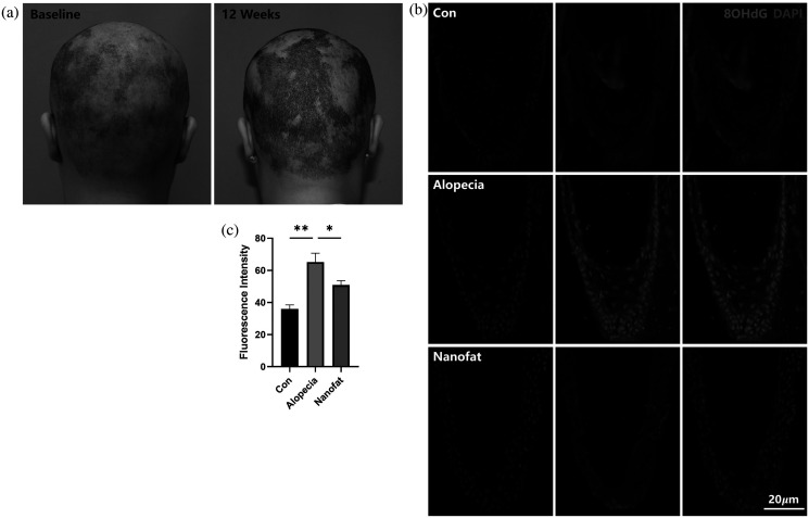 Oxidative stress activates the transplanted adipose-derived stem cells to exert antioxidant effects in alopecia treatment.