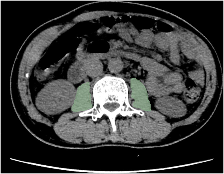 Psoas muscle CT radiomics-based machine learning models to predict response to infliximab in patients with Crohn's disease.