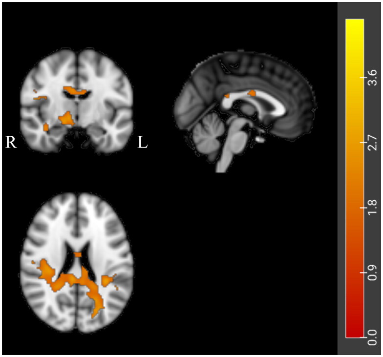Unveiling structural damage of the corpus callosum in amyotrophic lateral sclerosis through diffusion tensor imaging and spread direction perspectives.