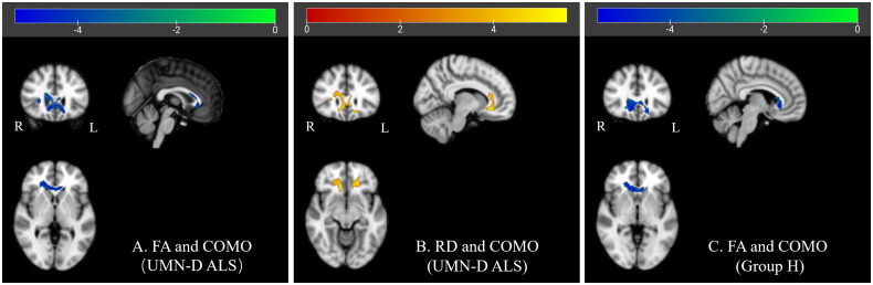 Unveiling structural damage of the corpus callosum in amyotrophic lateral sclerosis through diffusion tensor imaging and spread direction perspectives.
