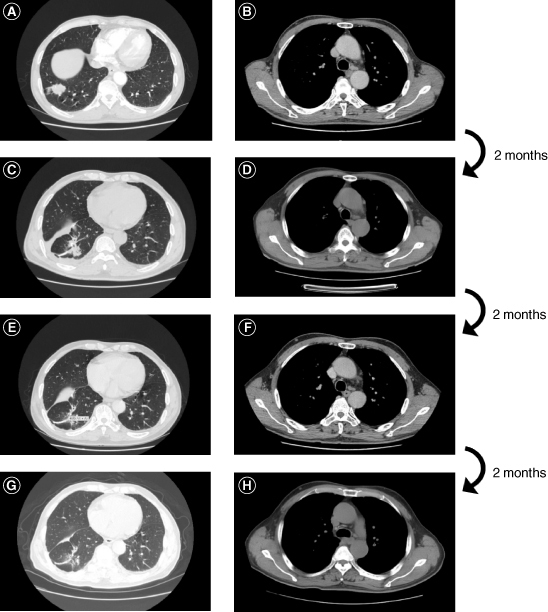 Oncogenic <i>ALK</i> fusion in rare subtype of small intestine metastasis from occult lung cancer.