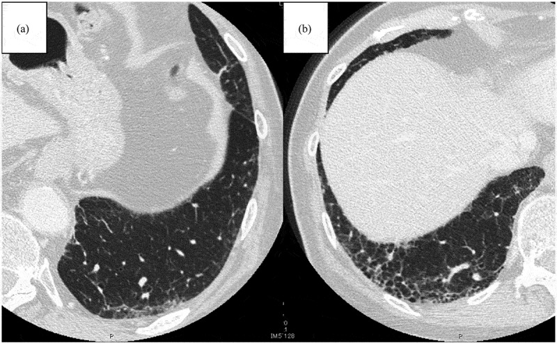 Interactions between interstitial lung abnormalities and immune checkpoint inhibitor therapy in non-small cell lung cancer: A review of current understanding and future directions.