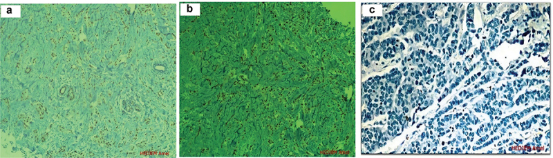 Androgen receptor expression in triple negative breast cancer: an Algerian population study.