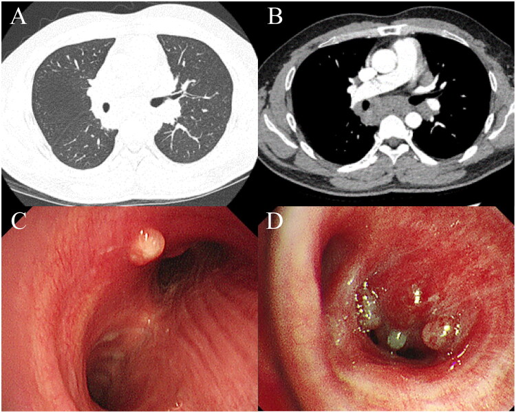 Clinical characteristics of pulmonary sarcoidosis in China: a retrospective, multicenter study.