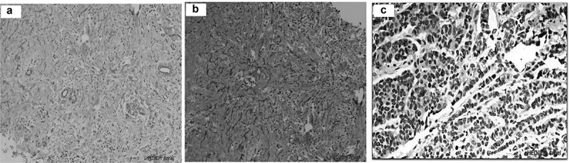 Androgen receptor expression in triple negative breast cancer: an Algerian population study.