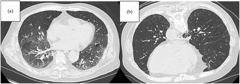 Interactions between interstitial lung abnormalities and immune checkpoint inhibitor therapy in non-small cell lung cancer: A review of current understanding and future directions.