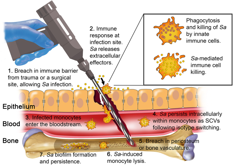 Intracellular survival of <i>Staphylococcus aureus</i> in macrophages during osteomyelitis.