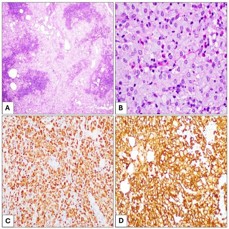 Whipple Disease Initial Presentation as Supraclavicular Lymphadenopathy in a Patient With Rheumatoid Arthritis: A Diagnostic Challenge.