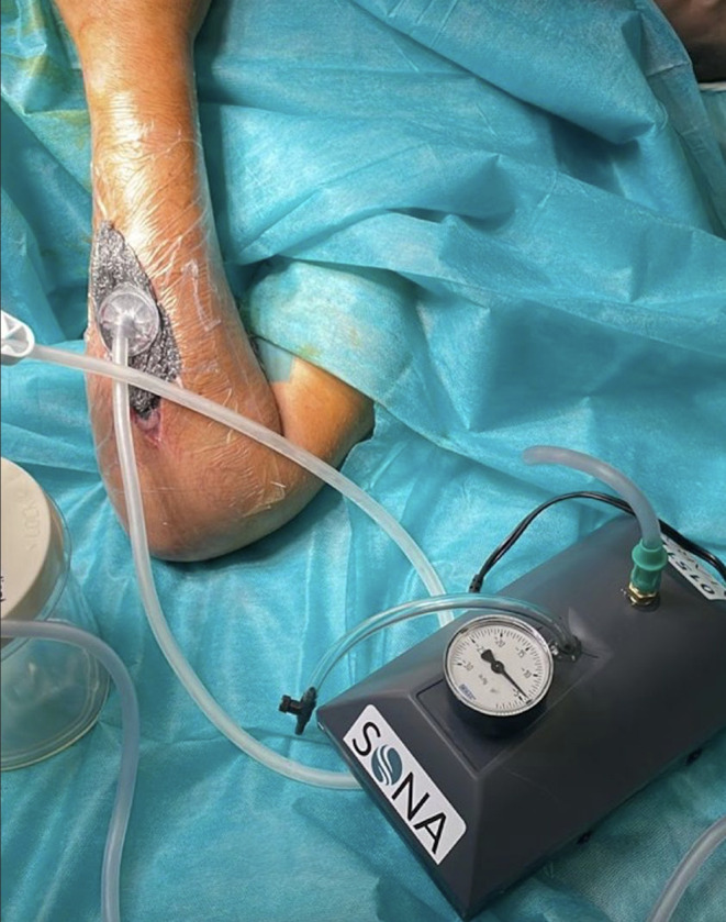 Frugal Innovations in Orthopaedics.