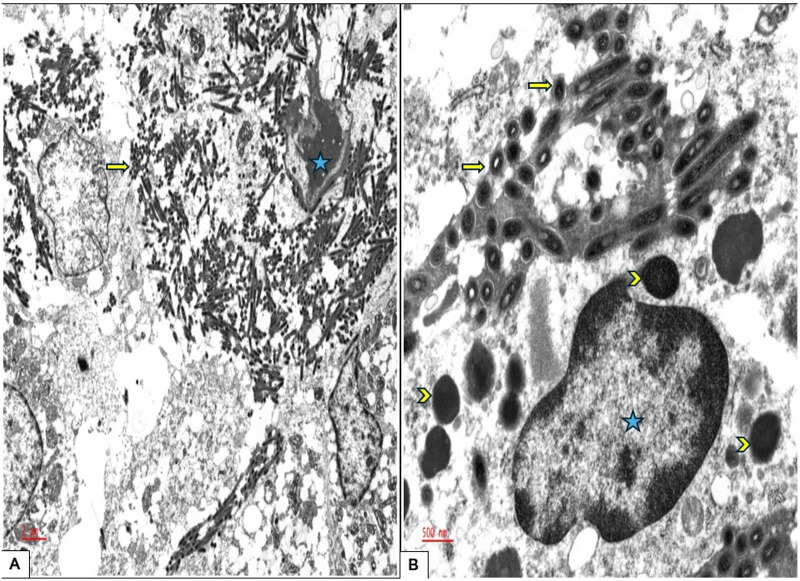 Whipple Disease Initial Presentation as Supraclavicular Lymphadenopathy in a Patient With Rheumatoid Arthritis: A Diagnostic Challenge.