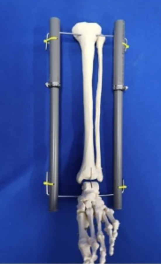 Frugal Innovations in Orthopaedics.