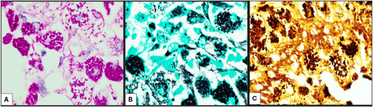 Whipple Disease Initial Presentation as Supraclavicular Lymphadenopathy in a Patient With Rheumatoid Arthritis: A Diagnostic Challenge.