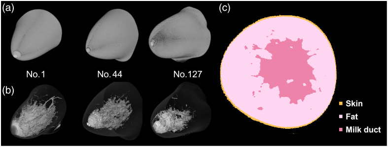 Prediction of the photodynamic therapy effect using digital breast phantoms from patients with breast cancer via Monte Carlo simulations.