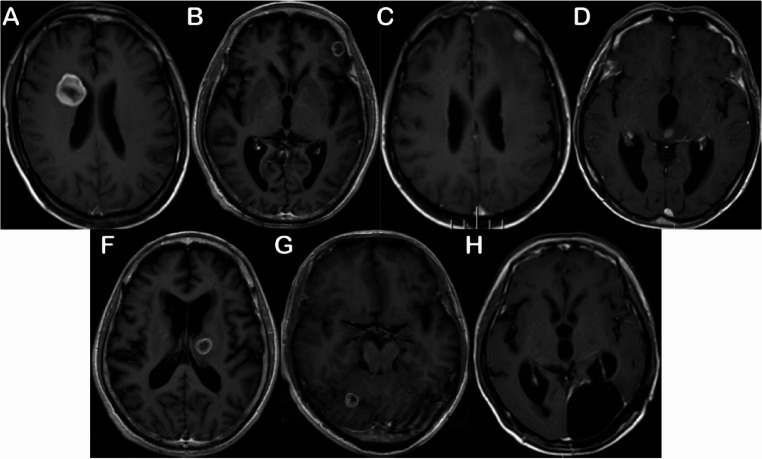 Development and validation of a predictive nomogram for leptomeningeal metastasis risk in NSCLC brain metastases: role of tumor location, driver mutations, and stereotactic radiosurgery.