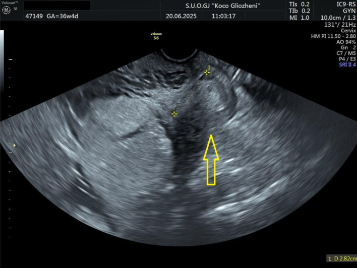 Anesthetic and Transfusion Management in Placenta Accreta Spectrum: Lessons From a Resource-Limited Setting and Mini-Review.