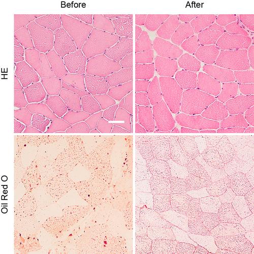 2-[18F] FDG PET/CT in Rapid Late-Onset Multiple Acyl-CoA Dehydrogenase Deficiency: A Case Report