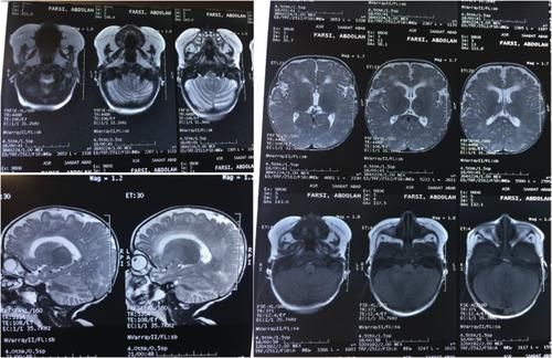 Unusual Presentation of Classical Galactosemia: A Case Report of Iranian Experience