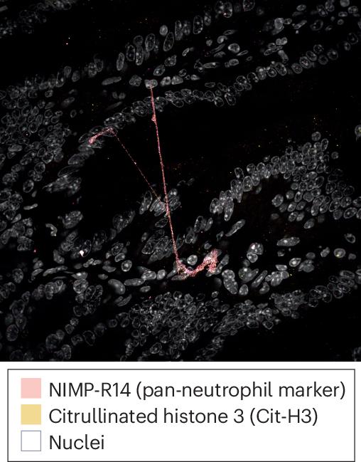 Neutrophils might link intestinal damage to retinopathy in type 2 diabetes mellitus