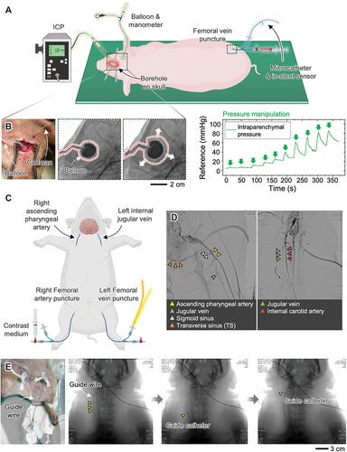 Non-Surgical, In-Stent Membrane Bioelectronics for Long-Term Intracranial Pressure Monitoring