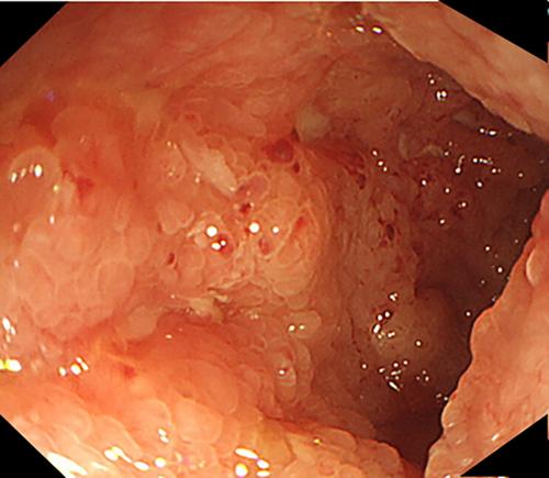 Eosinophilic enteritis: A case for awareness among primary care physicians