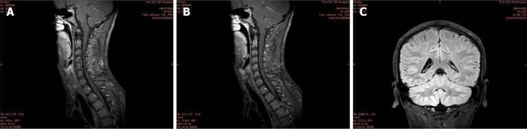 Treatment of a rare and severe infection of central nervous system by <i>Angiostrongylus cantonensis</i>: A case report.