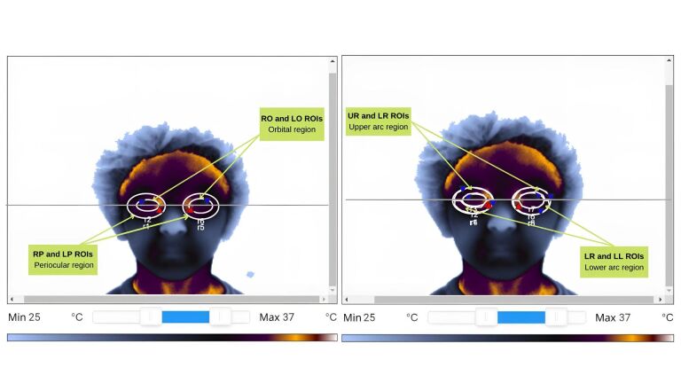 Thermographic analysis of the periorbital region in mouth and nasal breathing children.