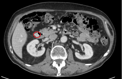 Incidentally Discovered Duodenal Gastrointestinal Stromal Tumour (GIST): Operative Treatment and Problems After Surgery-A Case Report and Literature Review.