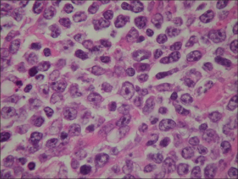 Successful Pregnancy after Fertility-sparing Surgery and Treatment for Metachronous Multiple Primary Malignancies - A Case Report.