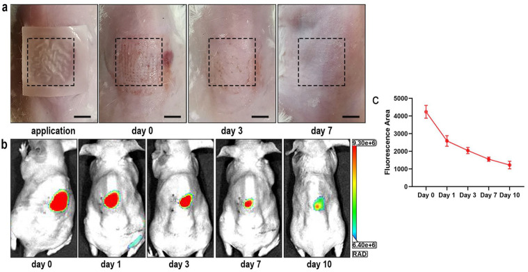 Dissolving microneedle patch loaded with adipokines-enriched adipose extract relieves atopic dermatitis in mouse via modulating immune disorders, microbiota imbalance, and skin barrier defects.