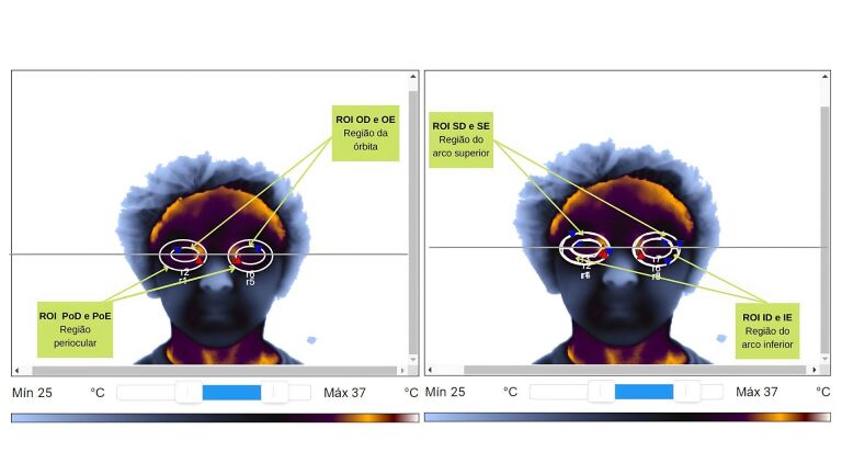 Thermographic analysis of the periorbital region in mouth and nasal breathing children.