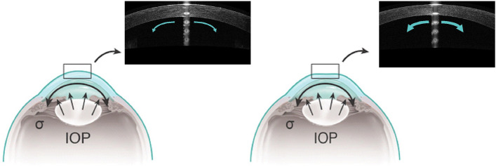 A novel corneal indentation device for comparison of corneal tangent modulus before and after FS-LASIK in vivo.