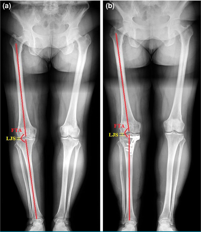 Proximal partial fibular resection versus high tibial osteotomy: Comparative outcomes in early-stage knee osteoarthritis.