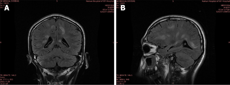 Treatment of a rare and severe infection of central nervous system by <i>Angiostrongylus cantonensis</i>: A case report.