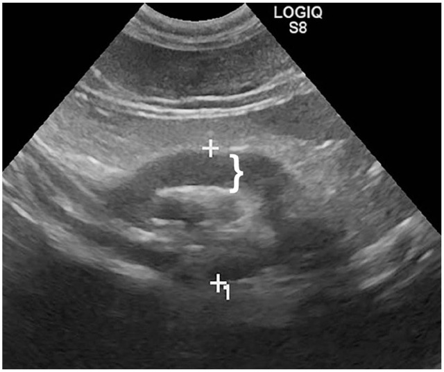 Feline eosinophilic sclerosing fibroplasia of the duodenum treated with gastrojejunostomy in a domestic shorthair cat.