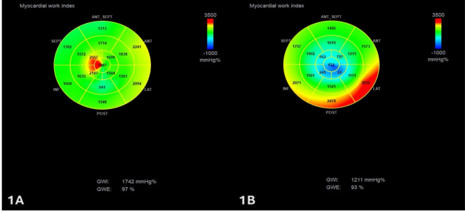 Assessment of myocardial work in sarcomere gene mutation carriers, healthy controls and overt nonobstructive hypertrophic cardiomyopathy.