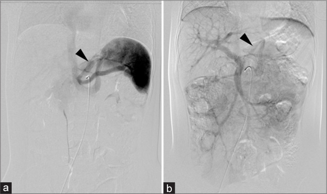 Long-term follow-up and transcatheter embolization of extrahepatic congenital portosystemic shunt with shifting hemodynamics.