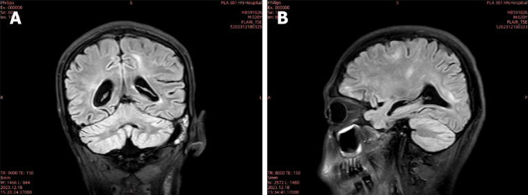 Treatment of a rare and severe infection of central nervous system by <i>Angiostrongylus cantonensis</i>: A case report.
