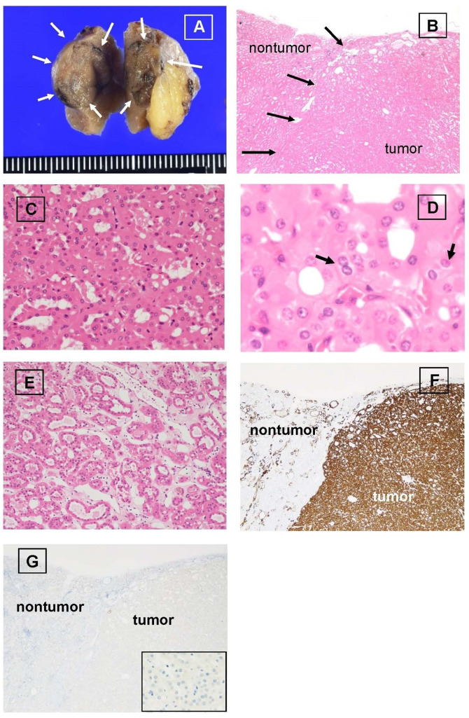 Whole exome sequencing identified mutations of forkhead box I 1 (FOXI1), keratin 6 C (KRT6C) and gap junction protein delta 2 (GJD2) in a low-grade oncocytic tumor of the kidney: a case report.