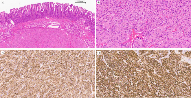 Incidentally Discovered Duodenal Gastrointestinal Stromal Tumour (GIST): Operative Treatment and Problems After Surgery-A Case Report and Literature Review.