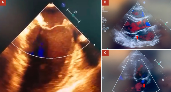Totally endoscopic periareolar approach for mitral valve repair. First case reported in Peru.