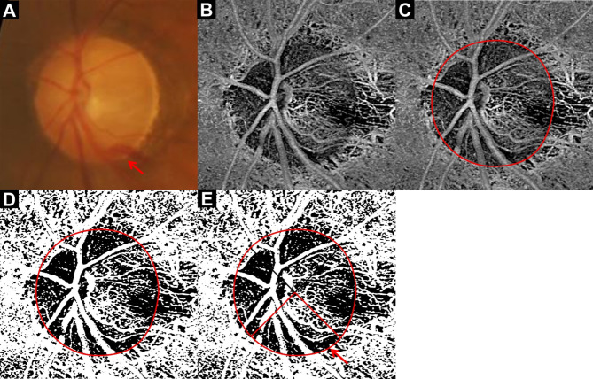 Changes in optic nerve head microvasculature following disc hemorrhage absorption in glaucomatous eyes.