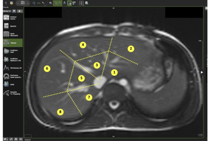 Liver T1 mapping in Fontan patients and patients with biventricular congenital heart disease - insights into the effects of venous congestions on diffuse liver disease.