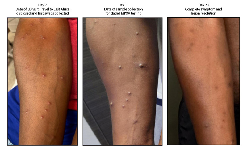 First Clade Ib Monkeypox Virus Infection Reported in the Americas - California, November 2024.