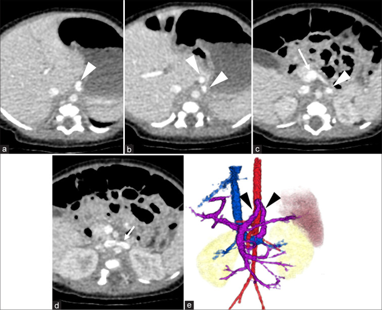 Long-term follow-up and transcatheter embolization of extrahepatic congenital portosystemic shunt with shifting hemodynamics.