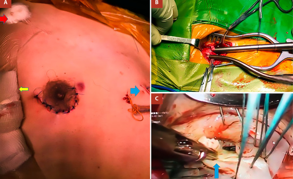 Totally endoscopic periareolar approach for mitral valve repair. First case reported in Peru.
