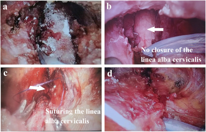 No closure of the linea alba cervicalis reduces complications in endoscopic thyroidectomy.