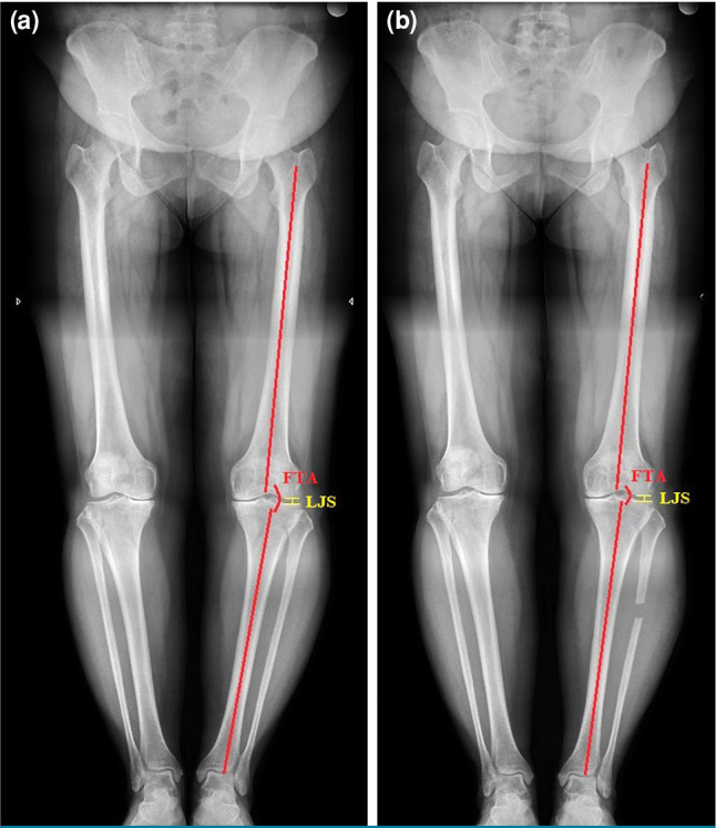 Proximal partial fibular resection versus high tibial osteotomy: Comparative outcomes in early-stage knee osteoarthritis.